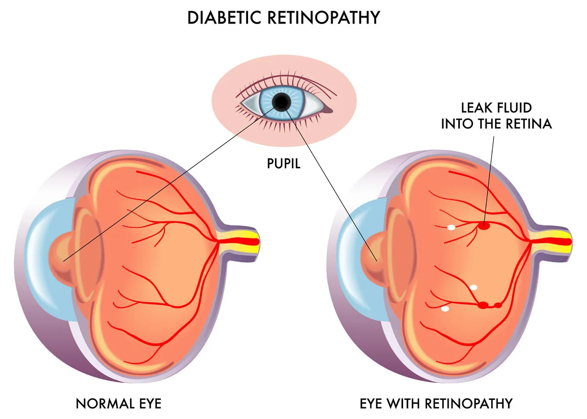 Diabetic Retinopathy