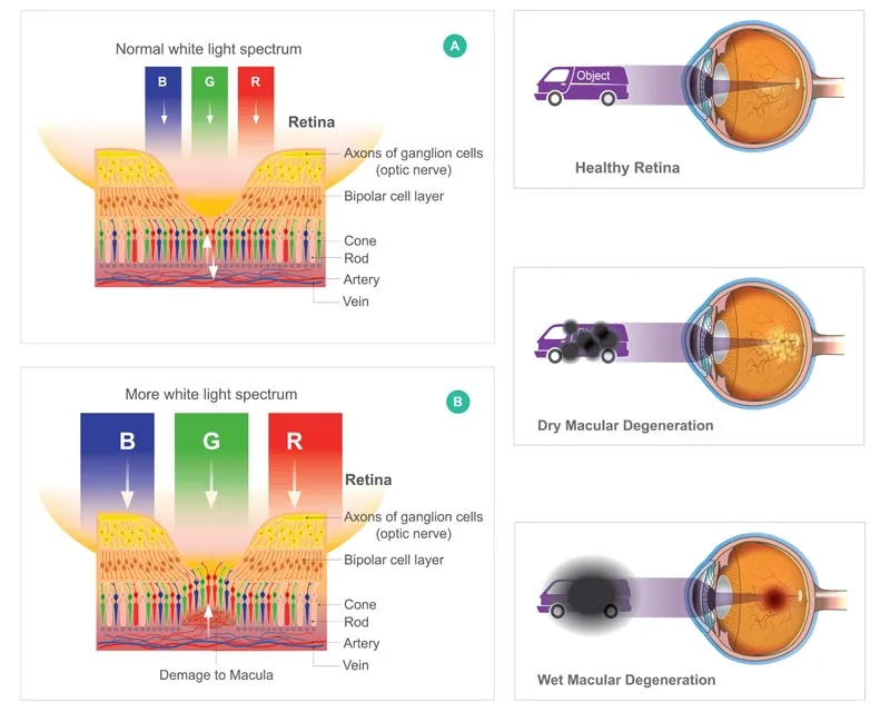Macular degeneration