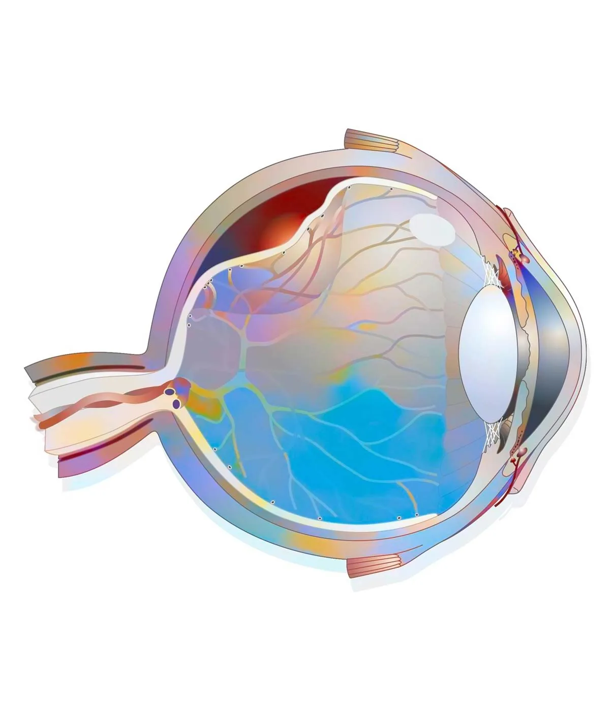 Retina Detachment