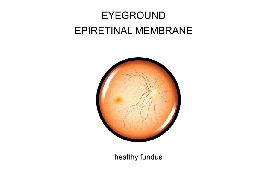 Epiretinal Membrane Surgery