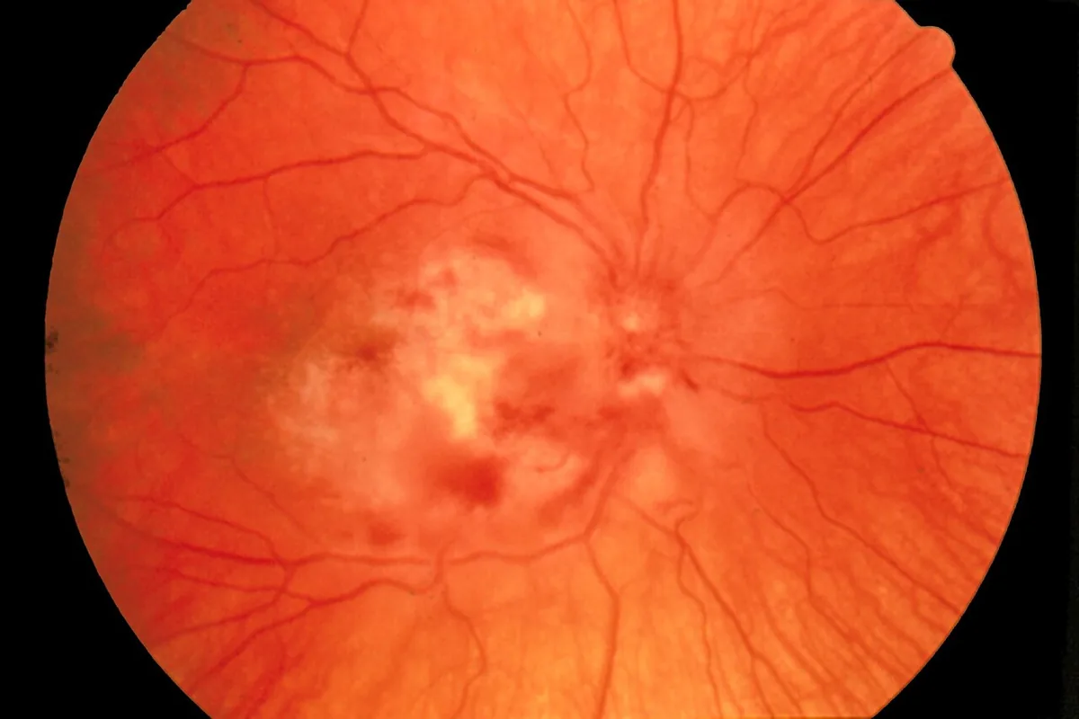 A retina affected by CMV retinitis, showing pale patches of damage and small haemorrhages along the vessels