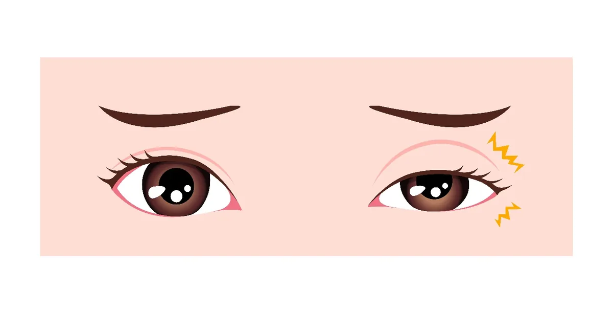 Illustration of involuntary eyelid closure in blepharospasm