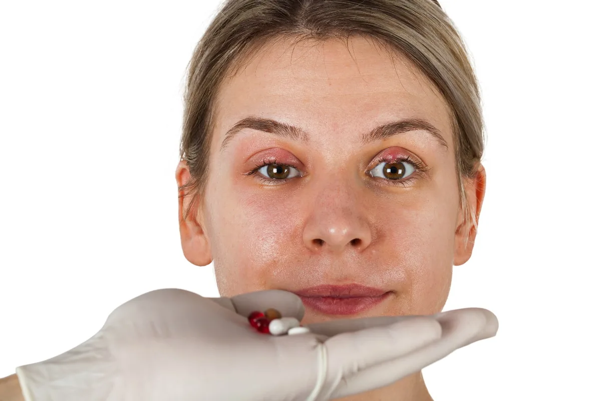 A swollen upper eyelid caused by a chalazion