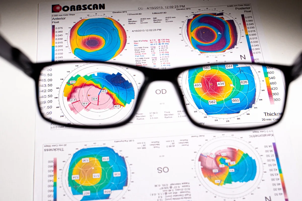 Colour-coded corneal topography maps of both eyes