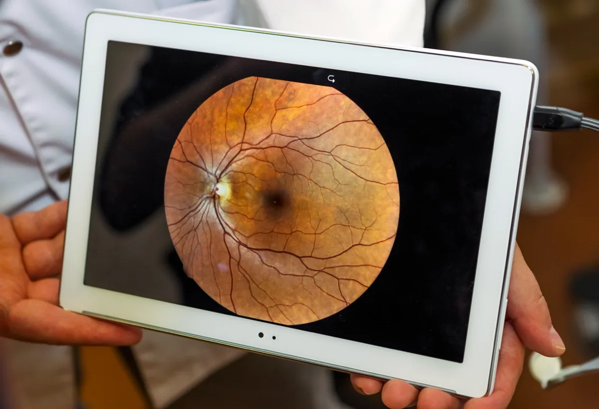 A digital photograph of the retina displayed for review