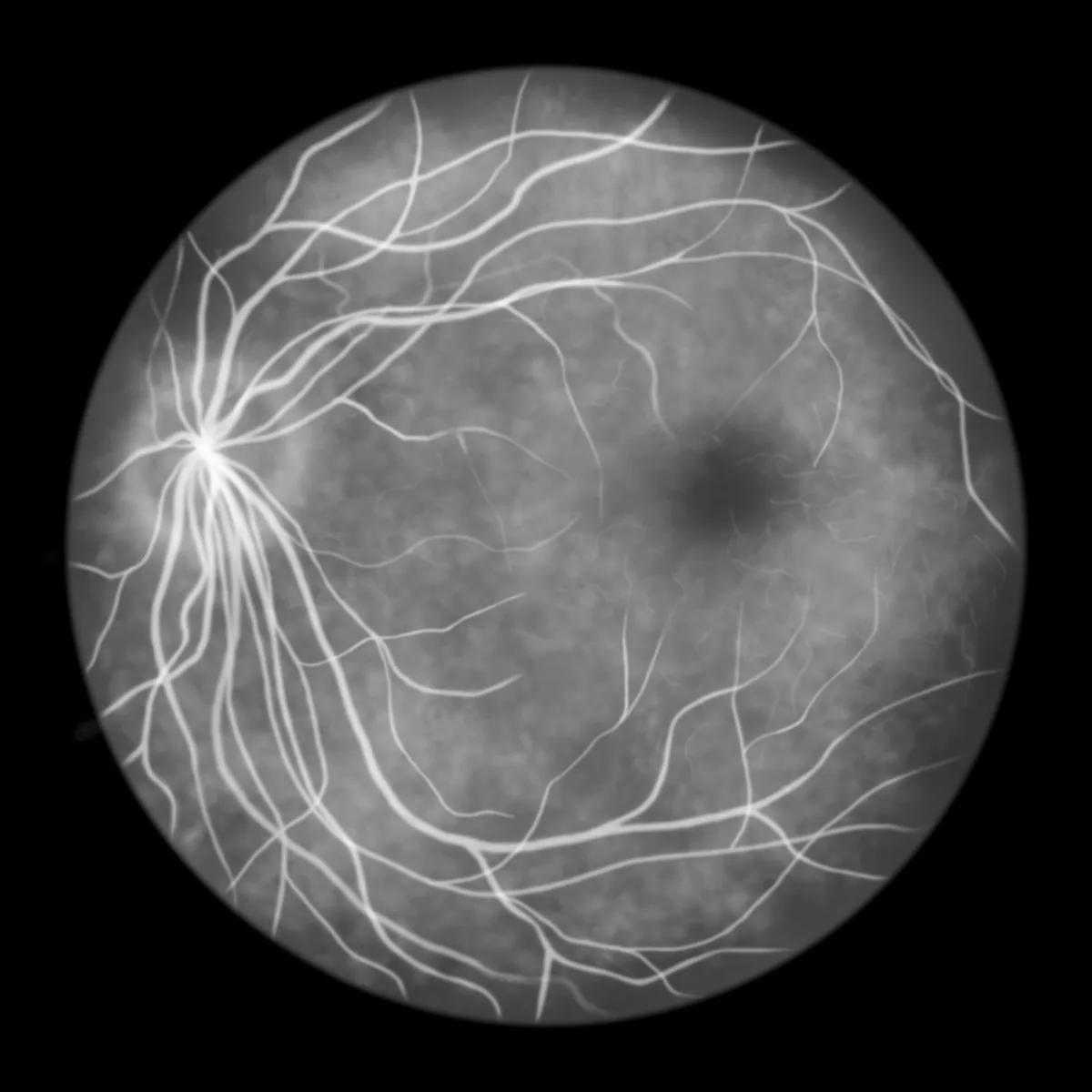 A fluorescein angiogram showing the retinal blood vessels filling with dye