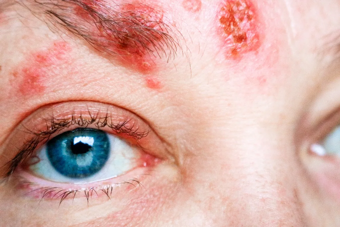 Shingles rash across the forehead and eyelid on one side of the face
