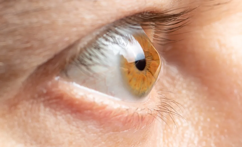 Close-up of an eye with a cone-shaped cornea