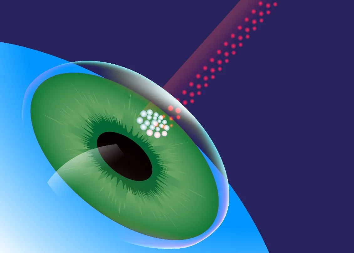 Illustration of the laser reshaping the surface of the cornea
