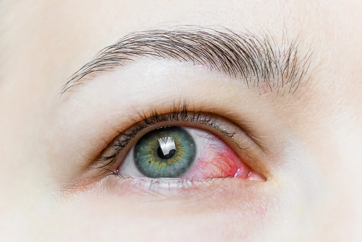 A red, inflamed eye in uveitis