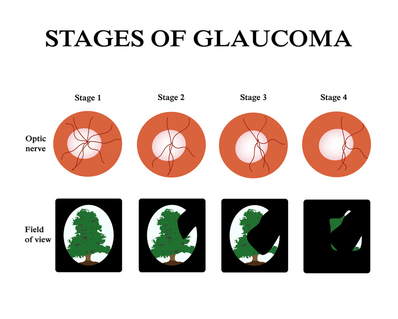 Glaucoma Surgery and Treatment