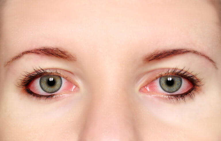 Corneal Abrasion - eye clinic