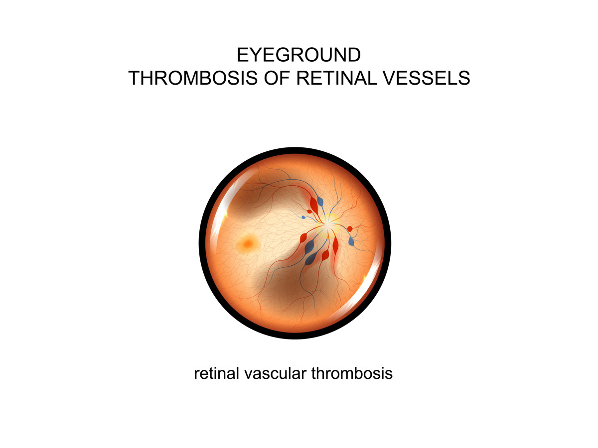 Retinal Vein Occlusion, Loss of vision