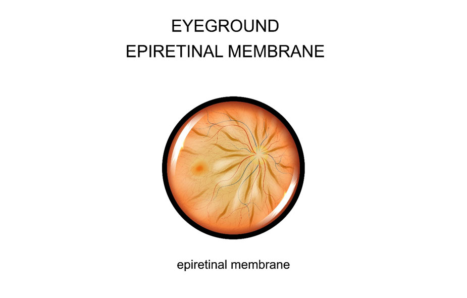 Epiretinal Membrane Surgery